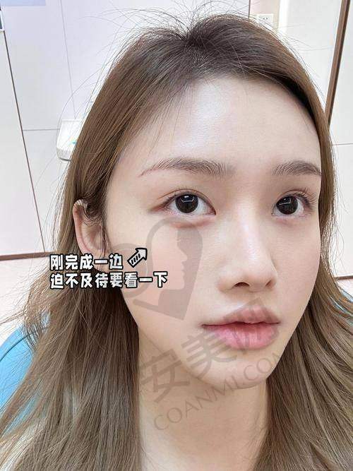 注射弗缦胶原蛋白的注意事项