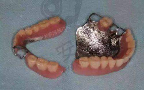 全口假牙佩戴后需要注意什么？