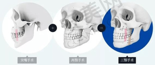 3、海口壹加壹胡晓枫医生整形技术怎么样？