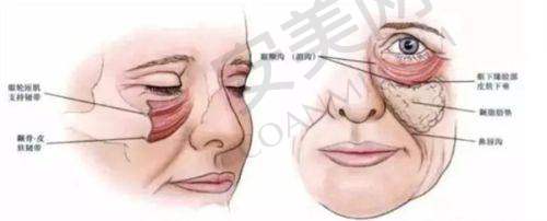 内切祛眼袋术后需要注意什么？