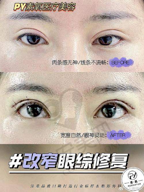 李燕初医生：眼整形领域的骨干医生风采