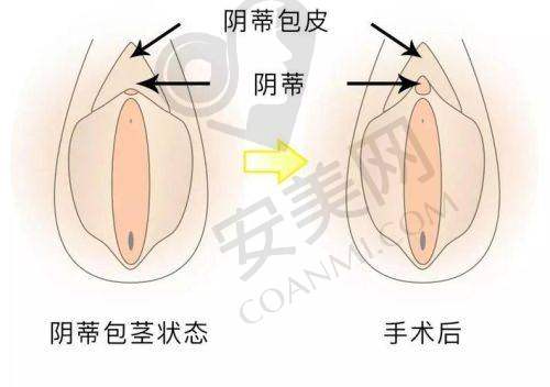 选择成都八大处小阴唇整形的理由是什么？