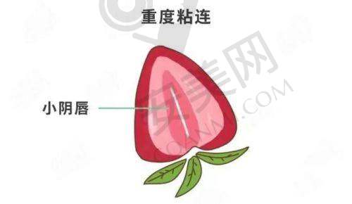 小阴唇整形能带来哪些改变？