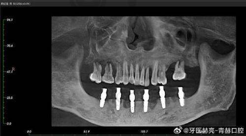 患者选择半口穿颧骨种植牙需要注意什么？