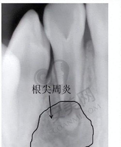 为什么选择合肥美奥口腔医院治疗牙周炎？