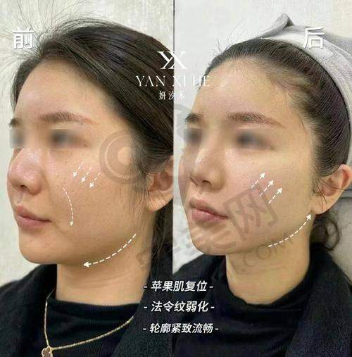 北京奥尔贝德轮廓固定值得尝试吗？