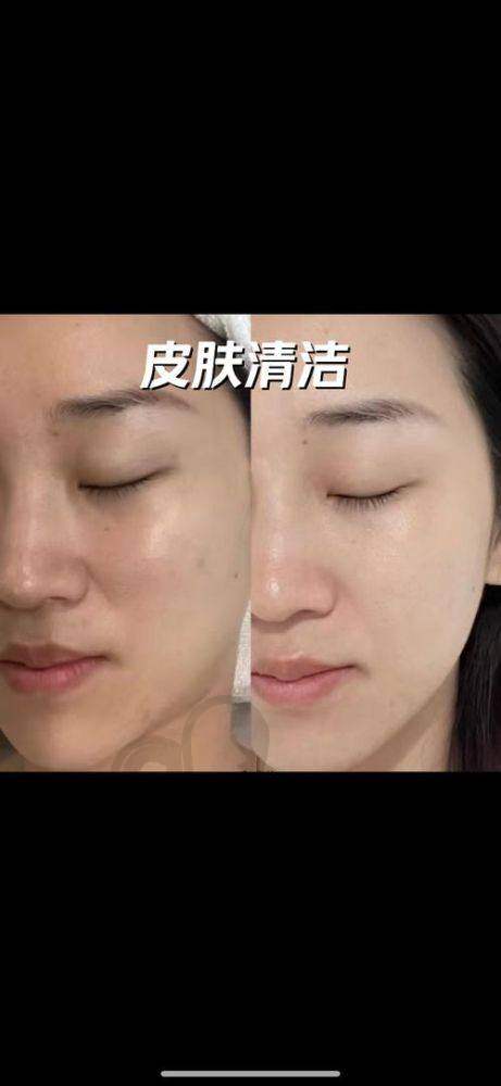 南宁华美皮肤光电治疗值得推荐吗？