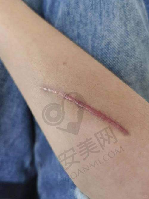苏州乐桥刘彦玲医生，开启增生疤痕修复之旅，仅需9800元起！ 
