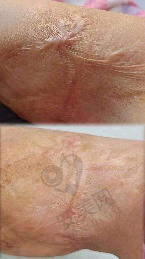 患者实例分享：见证增生疤痕修复奇迹