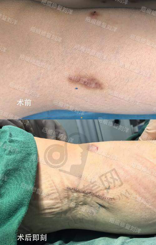 选择苏州乐桥刘彦玲医生修复增生疤痕的优势总结
