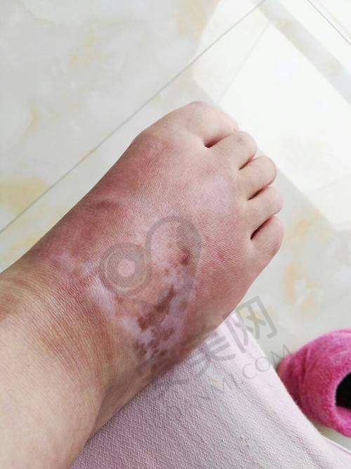 治疗期间的护理重要吗？