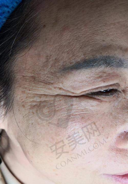 打除皱针疼不疼？过程是怎样的？