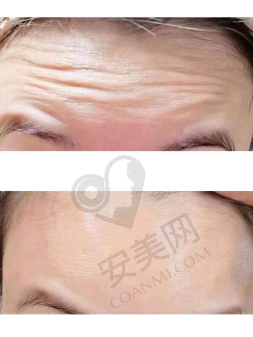 北京嘉禾打除皱针祛抬头纹的技术特色在哪里？