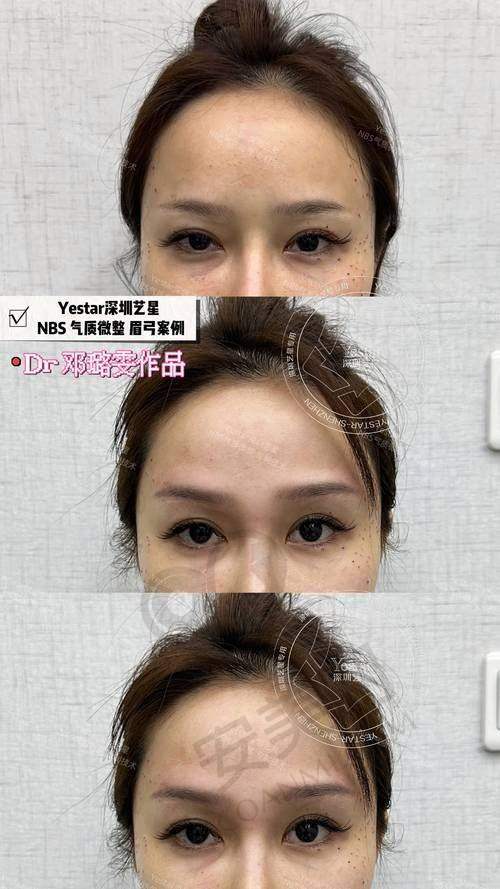 注射后的成效和修复情况如何？