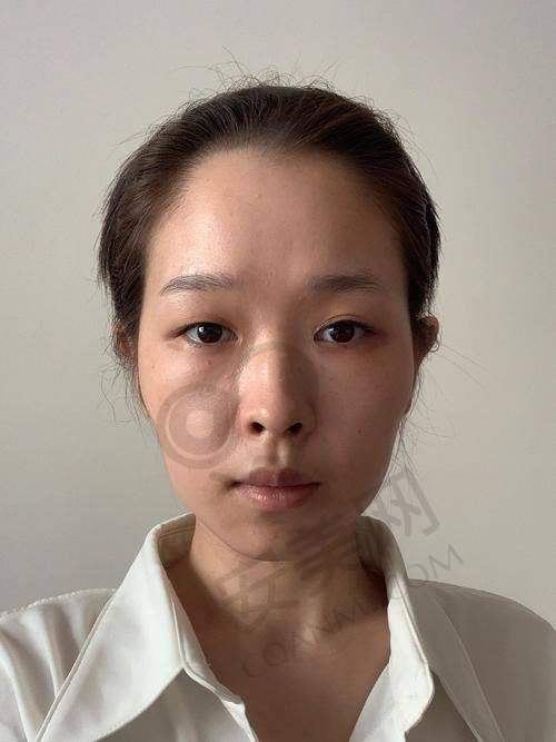 面部脂肪填充的价格构成及影响因素