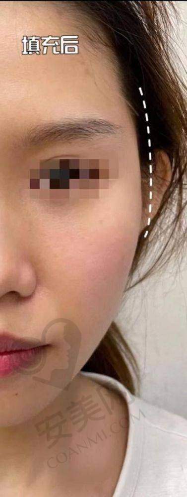 总结：成都八大处整形医院注射玻尿酸值得尝试吗？