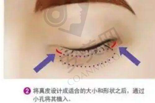 3、揭阳和美张全镇医生整形技术怎么样？