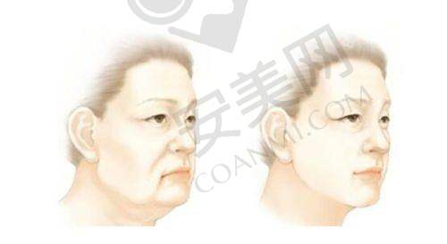 成都西区医院宋华敬抽脂的真实价值