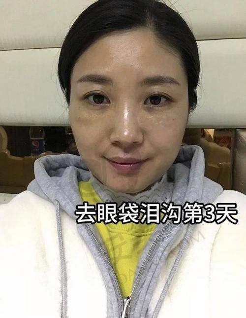 手术过程是怎样的？疼不疼？