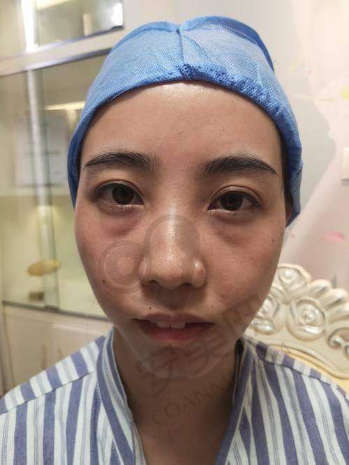 上海优嘉美无痕加法祛眼袋是什么？靠谱吗？