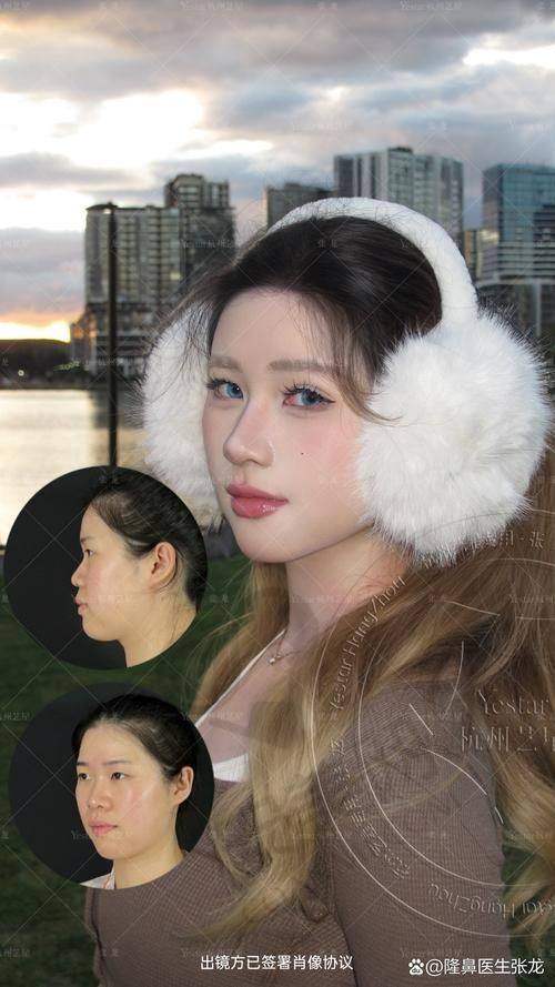 选择广州壹加壹肋软骨隆鼻需要注意什么？