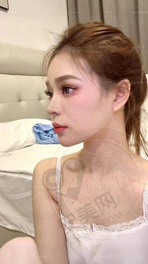 什么是肋软骨隆鼻？