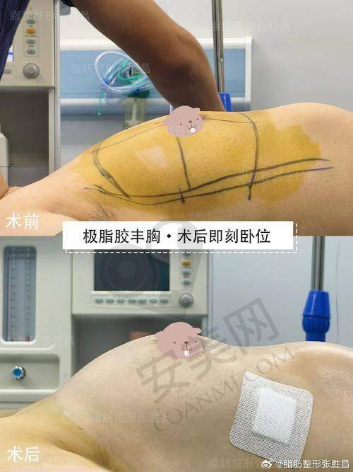 广州中家医家庭集体隆胸的诊疗成效怎么样？