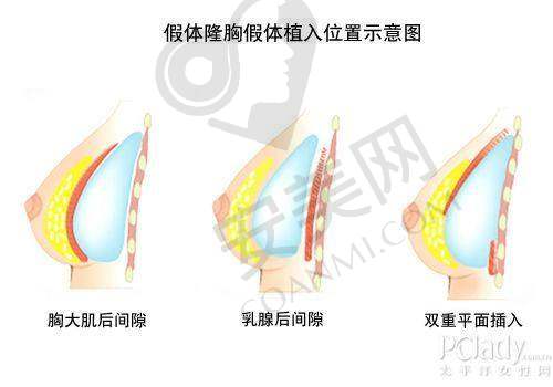 广州中家医家庭集体隆胸是什么样的体验？