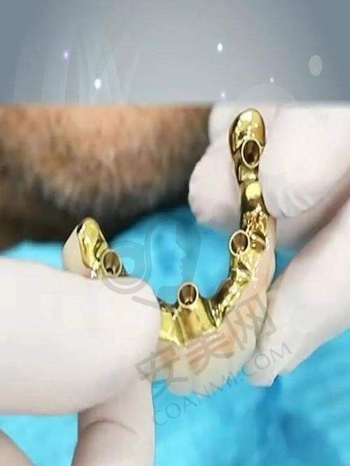 重庆种博士口腔郭颖all - 4半口种植牙价格为何是42000元起？