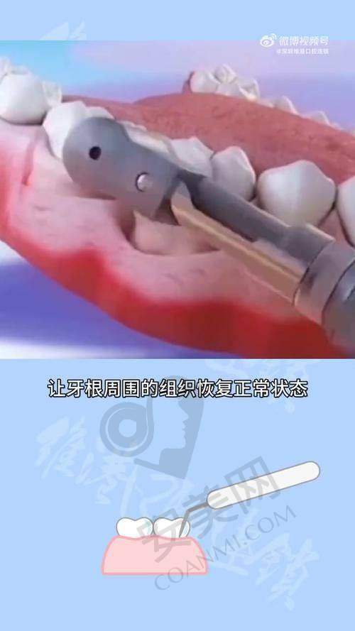 烟台壹颗芽口腔胡庆莹医生牙周刮治的流程是怎样的？