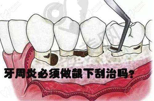 为什么要选择烟台壹颗芽口腔的胡庆莹医生进行牙周刮治？