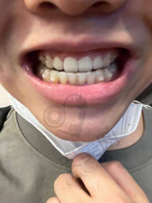 正雅隐形矫正是什么？为何如此受欢迎？