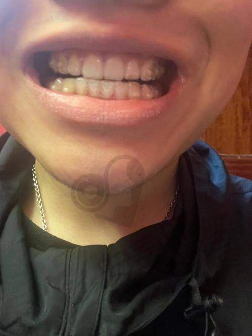 如何选择适合自己的正雅隐形矫正方案？