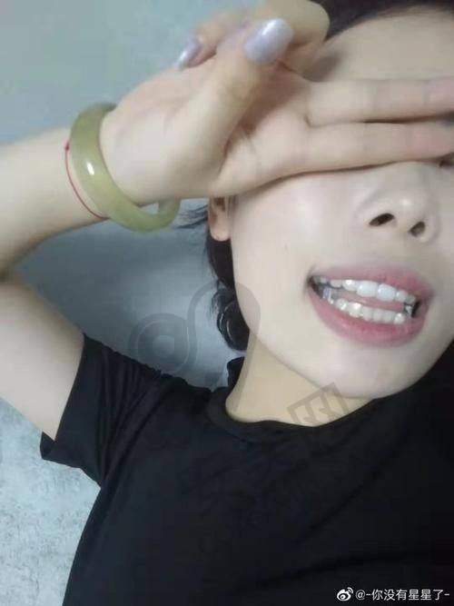 重庆中三口腔正雅隐形矫正的后续服务如何保护？