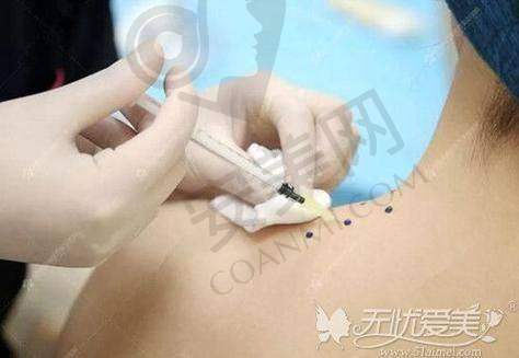 顾客见证：直角肩带来的美丽蜕变