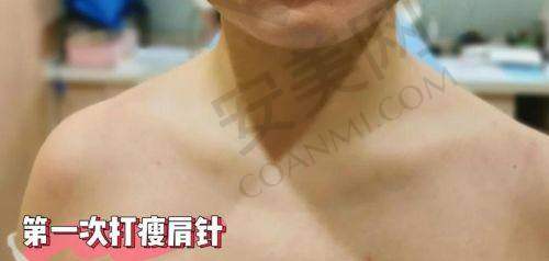 总结：开启美丽新体验，从直角肩开始