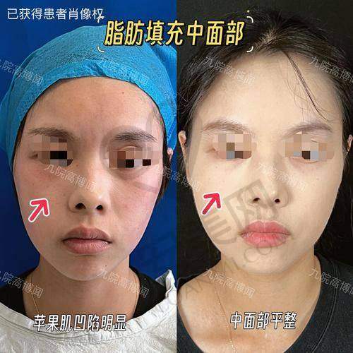 术后修复情况如何？