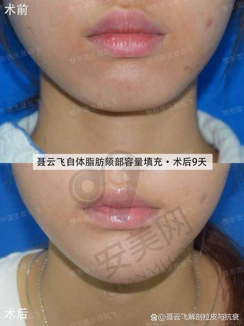 面部自体脂肪填充技术有什么特色？