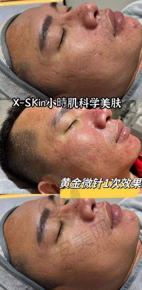温莉香黄金微针对肌肤有哪些好处？