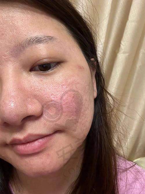 温莉香黄金微针治疗后需要注意什么？