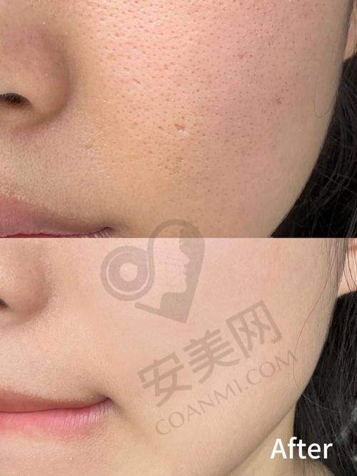 福州莳肌温莉香黄金微针值得尝试吗？