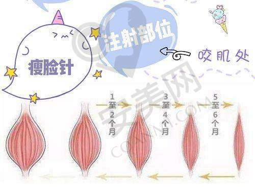 眼周筋膜提升的显著成效
