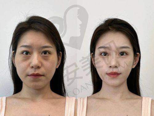 如何预约北京黄寺李晓东医生的PSV面部提升手术？