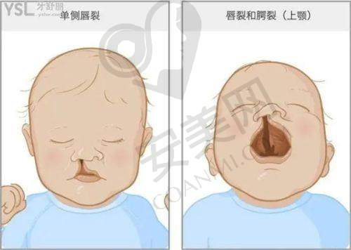 唇裂修复后患者能获得哪些改变？