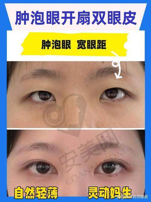 绍兴维美做双眼皮的术后成效好吗?