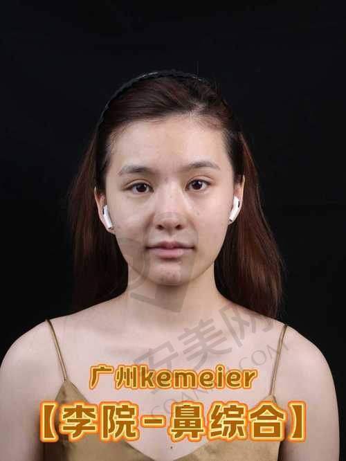总结：长春悦美汇孟宪勇医生鼻综合整形值得尝试吗？