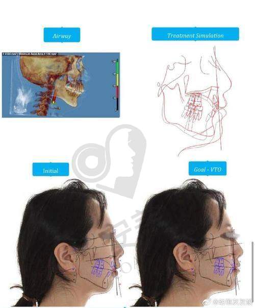 广州广大医院的双颚整形手术技术如何？