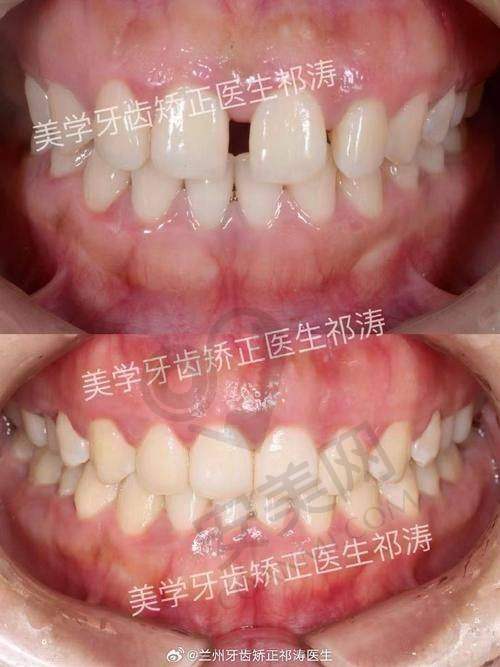 天津美铭口腔刘柳时代天使隐形矫正价格体系