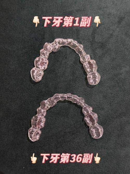 隐适美隐形矫正的成效如何？