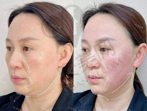 深圳阳光医院张英医生热玛吉价格是怎样的？